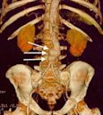 Abdominal aortic aneurysm