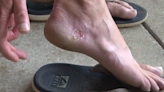 Man contracted a flesh-eating bacteria after walking on South Carolina beach
