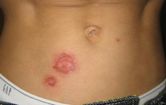 Bullous impetigo