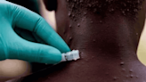 Salud: Kenia registra su primer caso mpox, antes viruela del mono