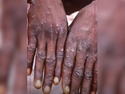 What is Mpox Clade 1 variant? All about this fast spreading strain in India