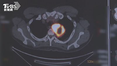 罹患「這個癌」年輕化關鍵因素是「它」！醫師：過半發現已晚期│TVBS新聞網
