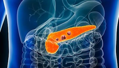 胰臟癌5年生存率只有12%！這些早期徵兆需警惕