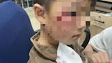 3歲男童遭大型犬攻擊 注射狂犬病疫苗仍發病「嘔吐+情緒狂躁」18天不治