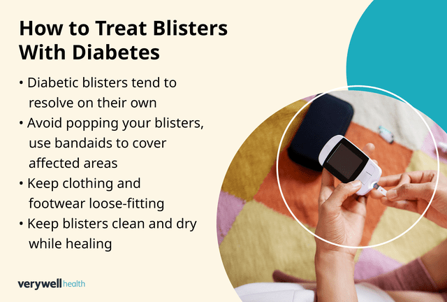 Diabetic Blisters: A Symptom of Mismanaged Diabetes?