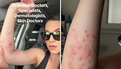 American baffled as "insect bite" from 2018 vacation is only getting worse