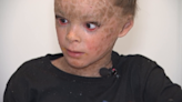 Boy with rare skin condition can't close his eyes