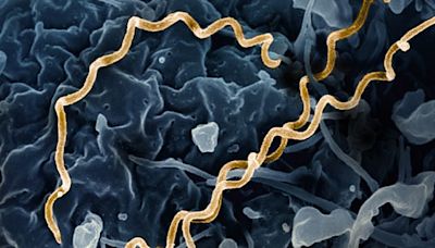 Doctors seeing more syphilis patients with unusual and severe symptoms, study shows