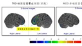 北榮首證實「頑固型憂鬱症」會遺傳 研究結果登上CNN