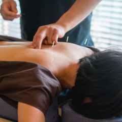 Acupuncture