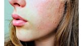 濕疹病患自行斷藥引發「皮膚類固醇戒斷症候群」 脫皮、掉屑、脫殼慘狀遭偷拍