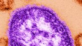 West Virginia confirms first measles case since 2009