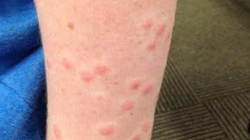 Swimmer's itch rash: See Ohio beaches with advisories, treatment, prevention information