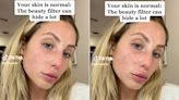 Alix Earle Shares Makeup-Free TikTok Without Beauty Filter to Show Her Acne: 'Just Know It's Normal'