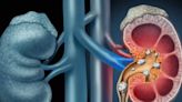 Diagnosed prevalent cases of chronic kidney disease to reach 22.97 mn across 7MM by 2033 : GlobalData - ET HealthWorld