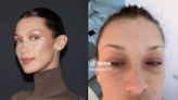 Bella Hadid shares update on Lyme disease diagnosis after suffering from tooth infection