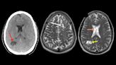 Doctors identify source of man’s migraines: tapeworm larvae, likely from undercooked bacon, in his brain