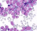 Acute myeloid leukemia