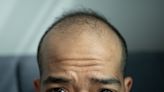 Doctor debunks five most common hair loss myths