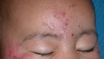 What Can Cause a Rash on My Baby's Face?