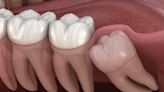 Dental Expert: Everything you want to know about wisdom teeth removal