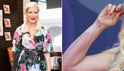 Tori Spelling Says She's 'Wearing My Thigh on My Arm' from Skin Graft After Falling on a Hot Hibachi Grill