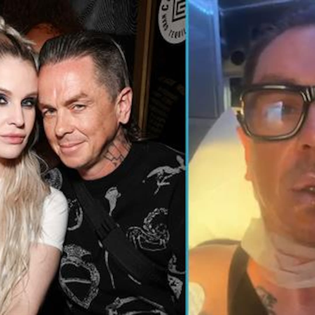 Kelly Osbourne's Boyfriend Sid Wilson Says His Face "Basically Melted" After Explosion - E! Online