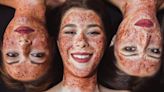 Three Women Infected With HIV Through ‘Vampire Facials’