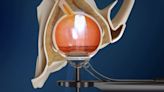 Stereotactic Radiotherapy Reduces Use of Anti-VEGF Therapy in Neovascular AMD