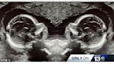 美國女子天生有雙子宮 產檢發現各有胚胎機率僅百萬分之一