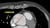 53歲女士意外發現大顆主動脈瘤 開心手術修復 - 自由健康網
