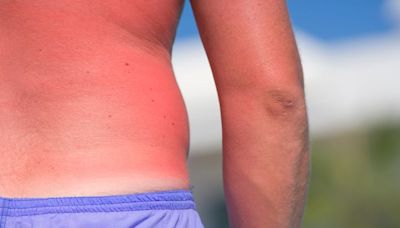 One sign means your sunburn is serious and you need urgent help