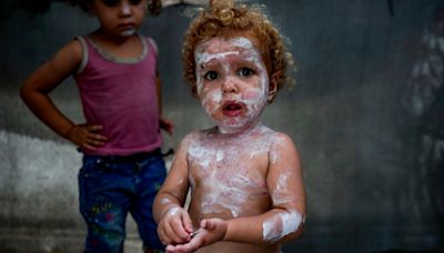 環境髒亂極度缺水 加薩兒童皮膚病患增、臉上身上布滿疹子