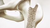 Estos son los síntomas y antecedentes que te llevarían a sufrir osteoporosis