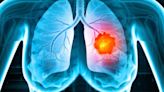 Lung Cancer: 5 Warning Signs You Can Spot On Face And Neck