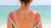 I treated my severe sunburn with an unexpected $8 drugstore buy