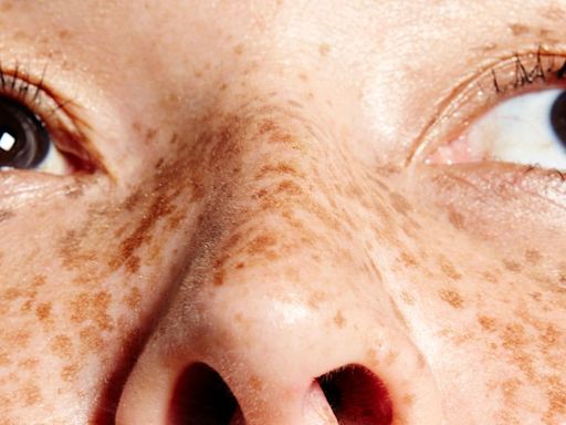 Freckles Are 'In' Now — And People Who Grew Up Hating Theirs Have Thoughts