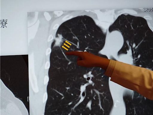 老菸槍摔倒竟是肺癌 精準「達文西」手術助治療 - 健康