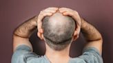 What Causes Alopecia (Hair Loss)?