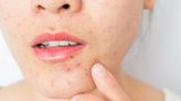 Stress can be "the triggering factor" for skin problems. Dermatologists share their advice.