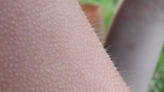 Why we don’t notice most of our goosebumps | Fox 11 Tri Cities Fox 41 Yakima
