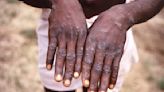 New deadly mpox strain could soon spread to US