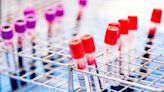 Alzheimer's Blood Test Outperforms Standard Diagnostics in New Study