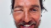 Matthew McConaughey shows off brutal bee sting