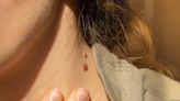 What causes skin tags and how do I get rid of them? - East Idaho News