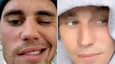 Justin Bieber Shows Off Mobility in His Face Following Ramsay Hunt Syndrome Diagnosis