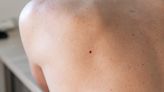 Older Than 30? You Might Start Noticing These Moles on Your Skin