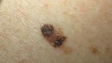 What Causes Moles to Suddenly Appear?