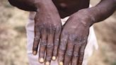 A new form of mpox that may spread more easily found in Congo’s biggest outbreak | Texarkana Gazette