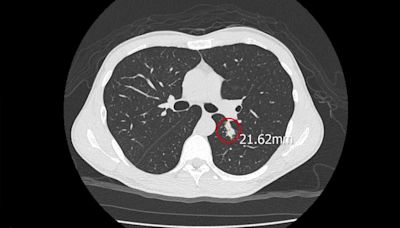 肺腫瘤以為罹癌！台中男沒出國竟患「罕見球黴菌」恐致呼吸衰竭│TVBS新聞網
